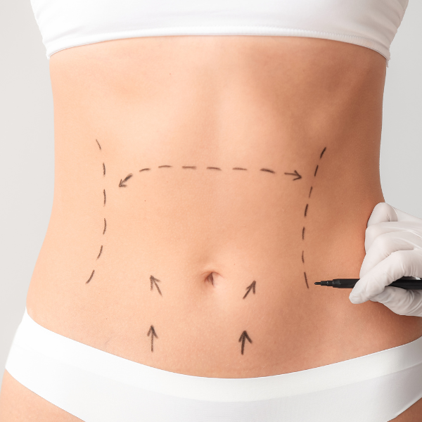 Tummy Tuck