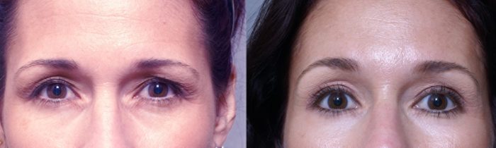 Brow Lift