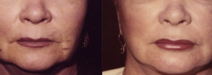 Lip Augmentation